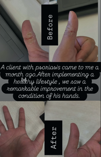 Psoriasis Management Success